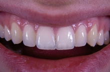 Τι είναι το χαμόγελο Ozempic 