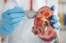 Καρκίνος του νεφρού: Η σιωπηλή απειλή που σήμερα μπορούμε να αντιμετωπίσουμε με επιτυχία