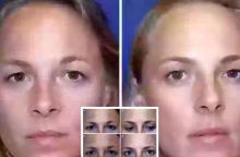 Μελέτη σε αποκαλύπτει τις μακροχρόνιες επιπτώσεις του μπότοξ - Επιστήμονες παρακολούθησαν δύο δίδυμες αδελφές επί 20 χρόνια