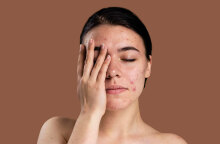 Ακμή: Γιατί παρουσιάζει έξαρση το καλοκαίρι;