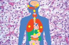 VHL σύνδρομο: Πώς είναι να ζεις με ένα σπάνιο νόσημα στην Ελλάδα του σήμερα