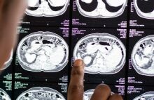 Καρκίνος: Εννιά εξετάσεις που πρέπει να κάνει κάθε ενήλικας για την πρόληψή του 