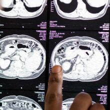 Καρκίνος: Εννιά εξετάσεις που πρέπει να κάνει κάθε ενήλικας για την πρόληψή του 