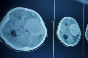  πέθανε από ναιγλερίαση που προκλήθηκε από μια σπάνια αμοιβάδα