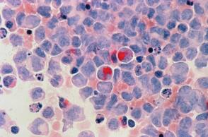 «Μαύρη» εκτίμηση ΠΟΥ: Τα κρούσματα καρκίνου θα αυξηθούν 75% έως το 2050