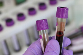 Αναπτύχθηκε «έξυπνο» τεστ αίματος που ανιχνεύει τον καρκίνο στο ήπαρ