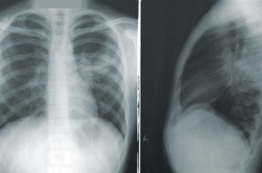 Μαγιορκίνης: Ραγδαία αύξηση της «Λευκής Πνευμονίας» - Πιθανότατα να έχει περιστατικά και στην Ελλάδα 