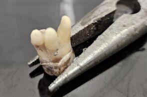 Βρετανία: Πολίτες αναγκάζονται να βγάζουν μόνοι τους τα δόντια τους