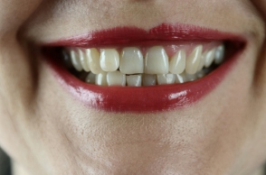 Κίτρινα δόντια: τα δύο λάθη που καταστρέφουν το χαμόγελό σας