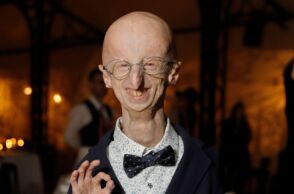 Ιταλία: Πέθανε ο Σάμι Μπάσο που έπασχε από σύνδρομο πρόωρης γήρανσης