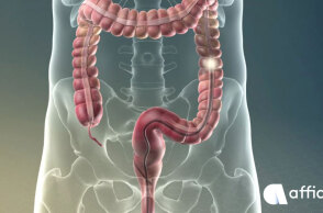 Καρκίνος Παχέος Εντέρου: Γιατί η κολονοσκόπηση είναι το κλειδί της πρόληψης