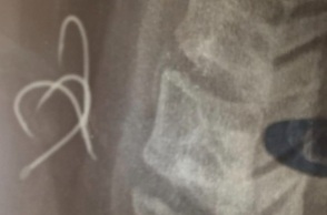 Αγρίνιο: 38χρονος έφαγε χταπόδι με αγκίστρι - Διακομίστηκε στην Αθήνα