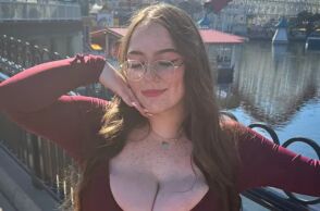 Σπάνια πάθηση αύξησε το στήθος 28χρονης κατά 11 μεγέθη σε έναν χρόνο