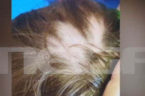 Αυλώνας: Συγκρούονται οι εκδοχές για το 2χρονο παιδί που έλειπαν τούφες από τα μαλλιά του