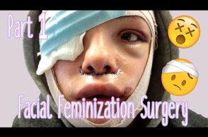 Facial Feminization Surgery - Day 1 & 2 (GRAPHIC) | Stef Sanjati