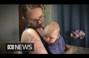 Mum risked her life to protect baby from giant hail | ABC News
