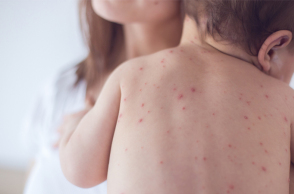 measles-preview.jpg