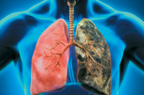 Καρκίνος του πνεύμονα
