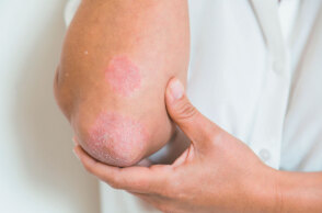 psoriasis-530693162-57810efc3df78c1e1ff59599.jpg