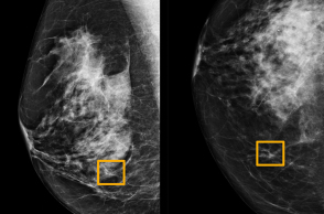 Μαστογραφία και τεχνητή νοημοσύνη