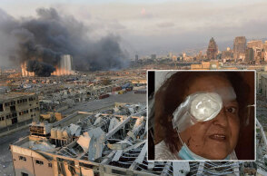 Έκρηξη στη Βηρυτό: Η Άννα Αρμάου, η Ελληνίδα που ζει μόνιμα στον Λίβανο και έχασε το μάτι της