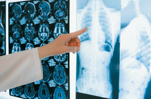 Ακτινογραφίες πνευμόνων