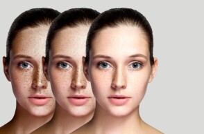 Σύγχρονες θεραπείες «σβήνουν» τα σημάδια του καλοκαιριού