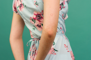 Ψωρίαση: Ποιες τροφές πρέπει να αποφεύγετε