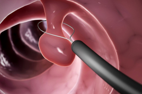 Καρκίνος παχέος εντέρου: Αποτελεσματική πρόληψη με κολονοσκόπηση