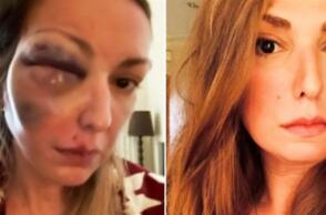 Μυστήριο με την Food Blogger που κατήγγειλε ότι έπεσε θύμα ξυλοδαρμού 