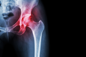 Αρθροπλαστικές ισχίου και γόνατος: Αλήθειες και μύθοι 