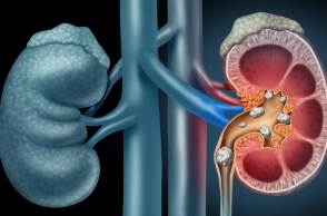 Πώς αντιμετωπίζονται σήμερα οι πέτρες στα νεφρά; 