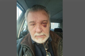 Ο Τάσος Χαλκιάς με μελανιασμένο μάτι μετά το ατύχημα