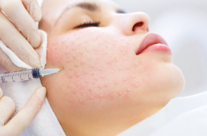 Προσφέρει όσα υπόσχεται η μεσοθεραπεία;