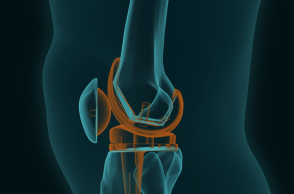 Aρθροπλαστική γόνατος και ισχίου: Τι ισχύει;