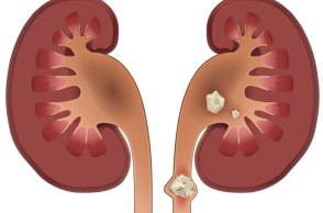 Αφαίρεση της πέτρας στα νεφρά με νέα ελάχιστα επεμβατική θεραπεία 