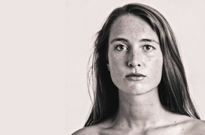 ασθενης με Νόσο του Χασιμότο