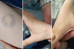 Άρτα: Διευθύντρια σχολείου δάγκωσε παιδί με αυτισμό