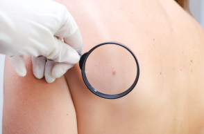 Μελάνωμα: Νεότερα δεδομένα δείχνουν αύξηση στους νέους 