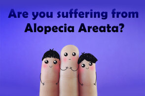 Αίτια, συμπτώματα και αντιμετώπιση της γυροειδούς αλωπεκίας 