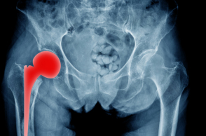 Oλική αρθροπλαστική ισχίου: Η τεχνική Super PATH