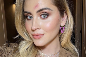 Η Valentina Ferragni με την ουλή στο πρόσωπο