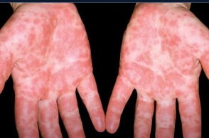 Η γρίπη της ντομάτας - Εξανθήματα στα χέρια