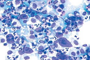 μη-Hodgkin λέμφωμα (ΜΗΛ)