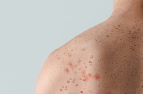 Νέα επιδημία mpox: Θα κάνουμε τα ίδια λάθη;   