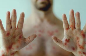 Ευλογιά των Πιθήκων: Ο ΠΟΥ ξεκαθαρίζει πως η mpox δεν είναι η νέα covid