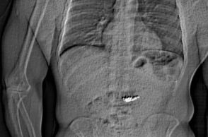 ΗΠΑ: Άνδρας κατάπιε κλεμμένα σκουλαρίκια Tiffany αξίας 769.500 δολαρίων λίγο πριν τη σύλληψή του - Εκκρεμούν 48 εντάλματα σύλληψης εναντίον του