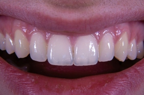 Τι είναι το χαμόγελο Ozempic 