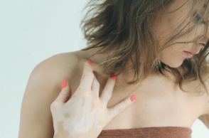 Λεύκη: Σύμμαχος ο δερματολόγος