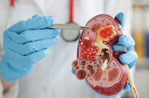 Καρκίνος του νεφρού: Η σιωπηλή απειλή που σήμερα μπορούμε να αντιμετωπίσουμε με επιτυχία